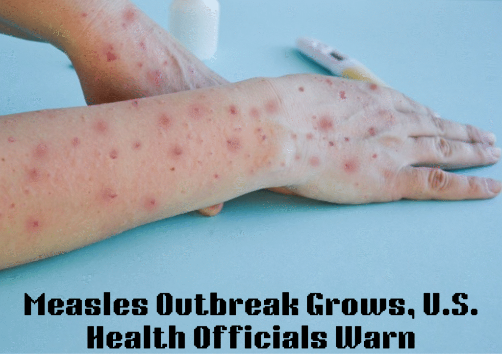 Measles Cases Surge Across the U.S., Prompting Renewed Public Health Warnings